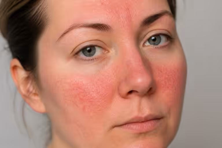 découvrez les causes, les symptômes et les solutions efficaces pour la rosacée sur le visage afin de mieux comprendre et gérer cette affection cutanée.
